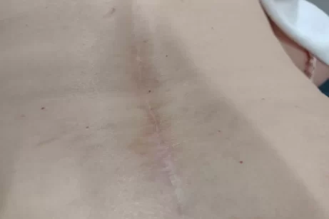 Scarwork in Newport after image